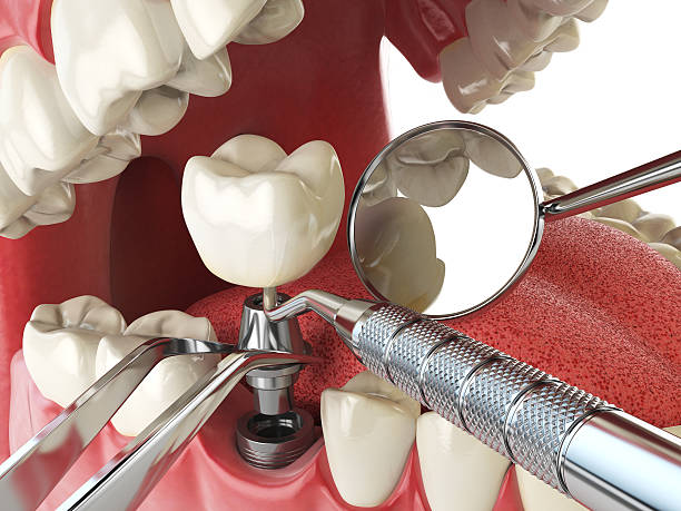 Best Emergency Root Canal Treatment in Lus Valley Marinwood, CA